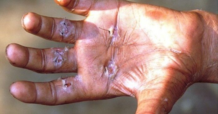 У Клужі зафіксували рідкісні випадки лепри: влада пояснила епідемічну ситуацію